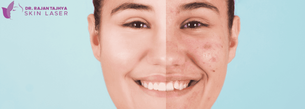 Acne and Acne Scar Removal