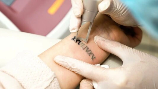 Tattoo Removal
