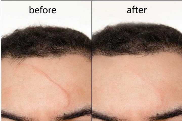 Scar Revision Surgery