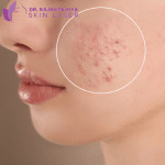 Acne & Acne Scar Removal