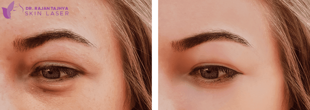 Asian Eyelid Surgery or Blepharoplasty