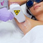 Diode Laser Hair Removal in nepal