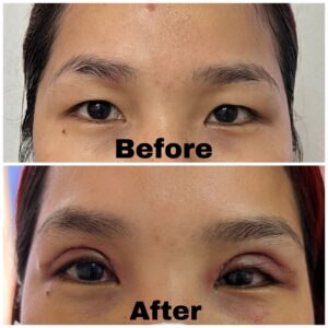 Eyelid Surgery After​ and before