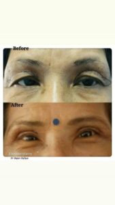 Eyelid Surgery Before and After​ 1