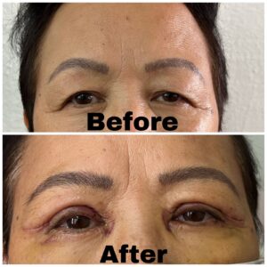 Eyelid Surgery Before and After​