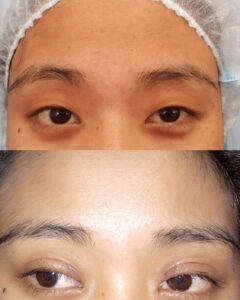 Eyelid Surgery Before and After​ asian