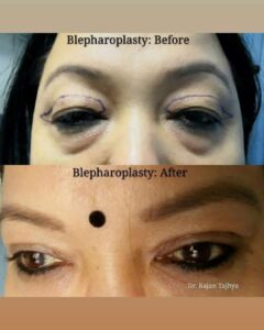 Eyelid Surgery Before and After​2