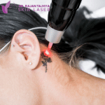 Laser Tattoo Removal in nepal