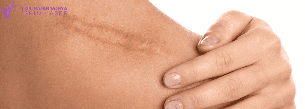 Scar Revision Surgery