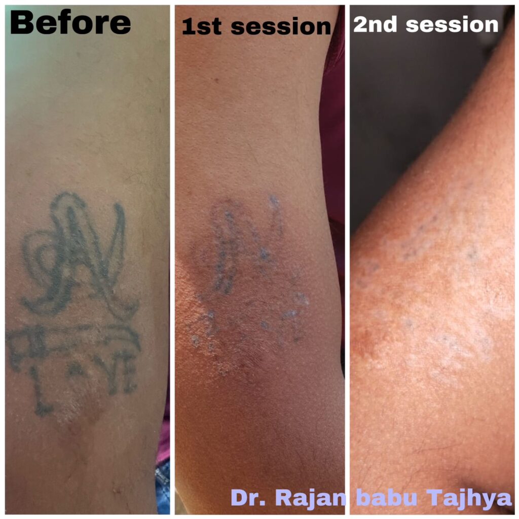 Tattoo removal after 2nd session