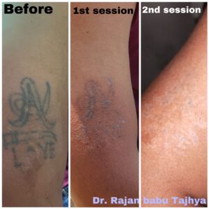 Tattoo removal after 2nd session