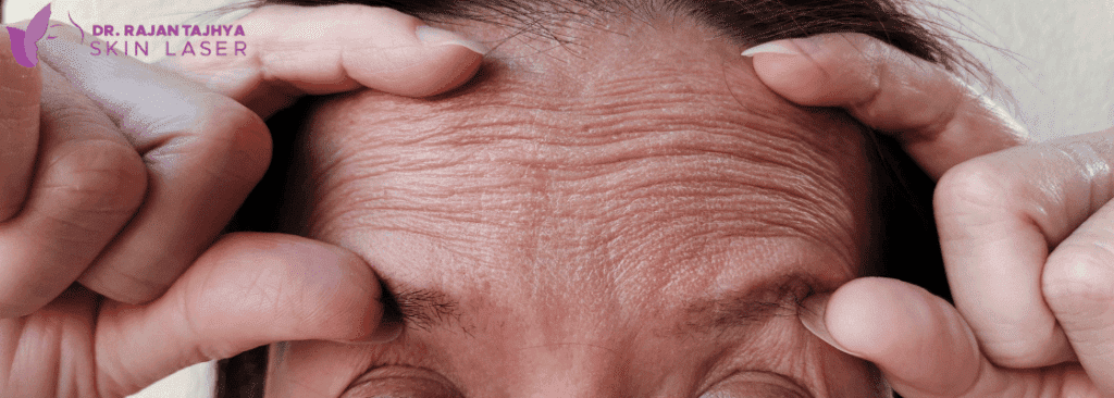 Wrinkle Reduction