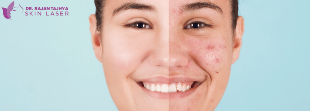 acne and acne scar treatment