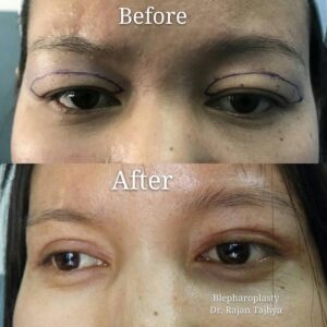 asian Eyelid Surgery Before and After​