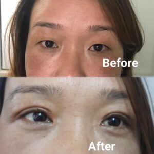 asian Eyelid Surgery Before and After​1