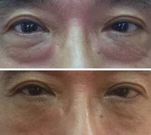 mongolian Eyelid Surgery Before and After​