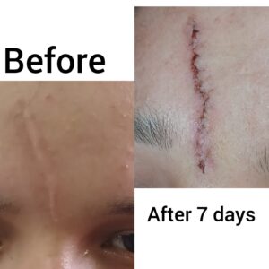 scar revision surgery in nepal 7 days