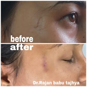 scar revision surgery in nepal 7 days before and after