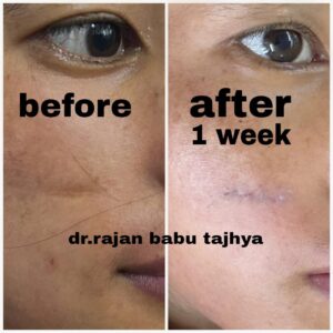 scar revision surgery in nepal after 1 week