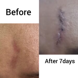 scar revision surgery in nepal after 7 days