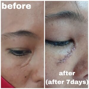 scar revision surgery in nepal after 7day