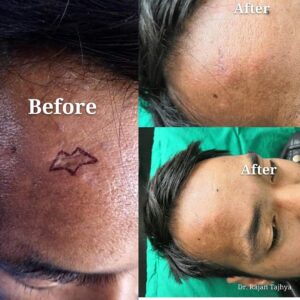 scar revision surgery in nepal before after