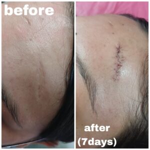 scar revision surgery in nepal before and after 7 day