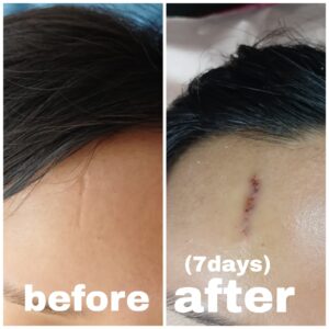 scar revision surgery in nepal before and after 7 days