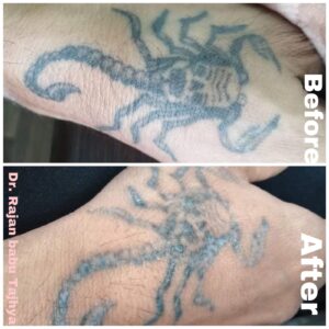 tattoo removal after 1st session (2)