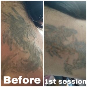 tattoo removal after 1st session (3)