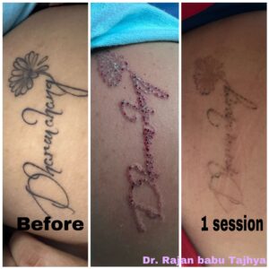 tattoo removal after 1st session