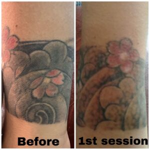 tattoo removal after 1st session (4)