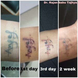 tattoo removal after 2 weeks