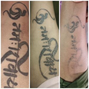 tattoo removal after 3rd session