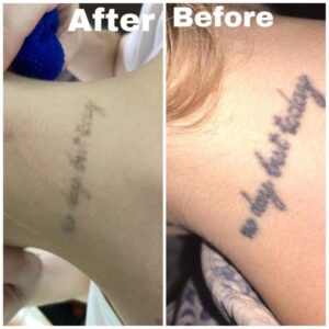 tattoo removal after and before (2)