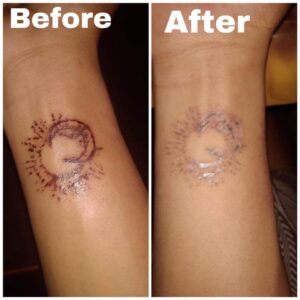 tattoo removal after and before (3)