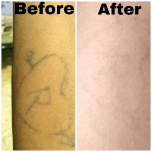 tattoo removal after and before