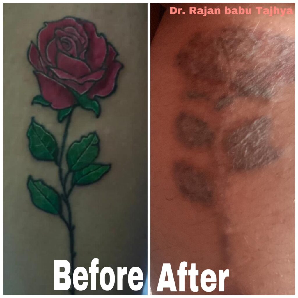 tattoo removal after before (2)