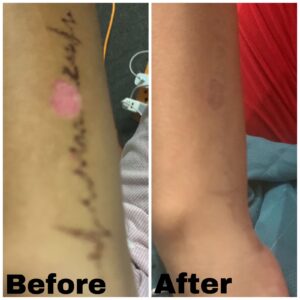 tattoo removal after before