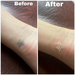 tattoo removal before after