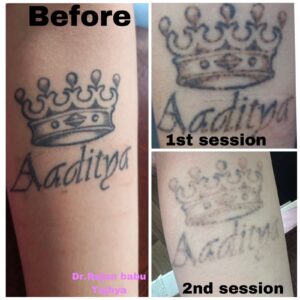 tattoo removal before after 2nd session