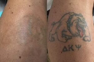 tattoo removal before & after