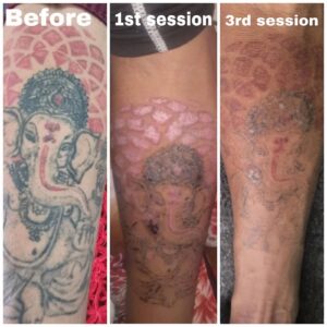 tattoo removal before after 3rd session