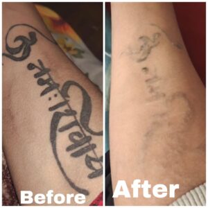 tattoo removal before and after