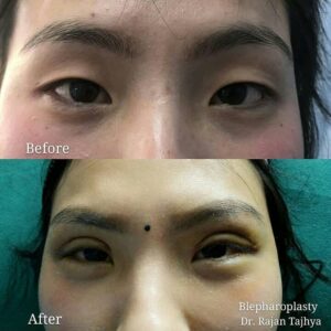 eyelid surgery (blepharoplasty surgery)